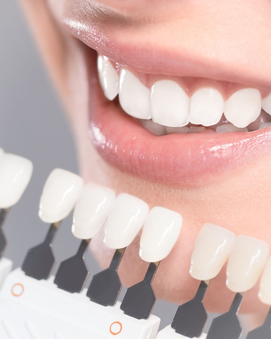 女性口元のきれいな歯と歯の白さの指標の写真