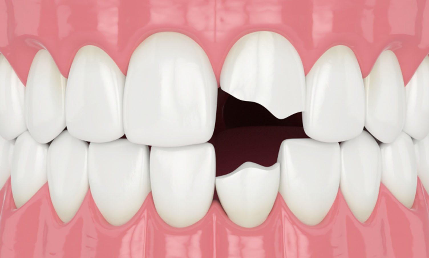 前歯が欠けたイメージ画像