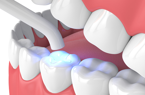 歯に充填したレジンに紫外線を照射している3Dイラスト