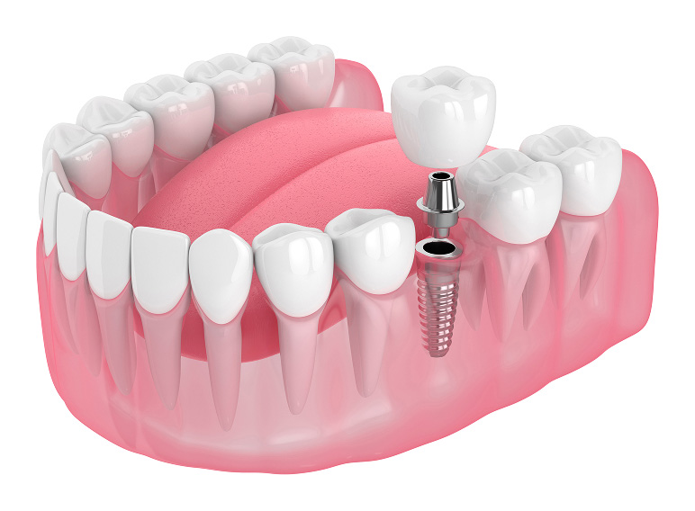 インプラントの3D画像