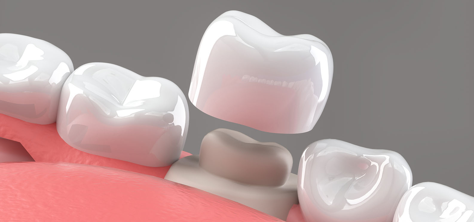 白い歯のクラウンを装着しようとしている3Dイメージ画像