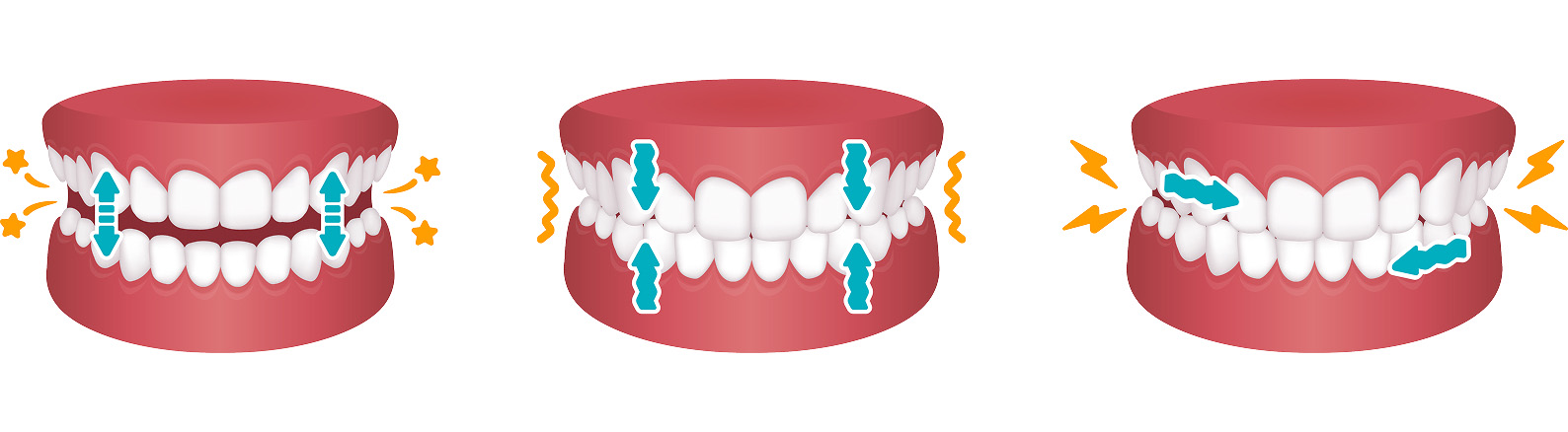 歯ぎしりの3Dイメージ画像