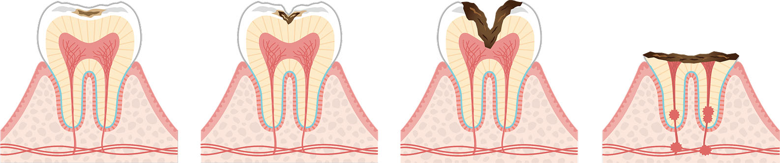 歯ぎしりの3Dイメージ画像