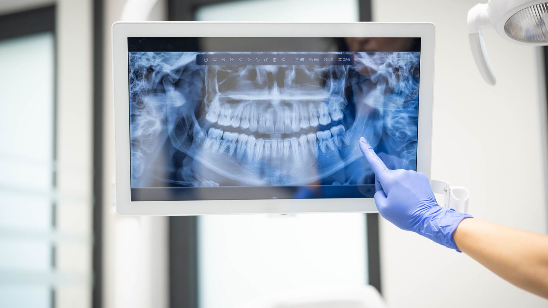 歯のレントゲンをPC画面に表示させている画像